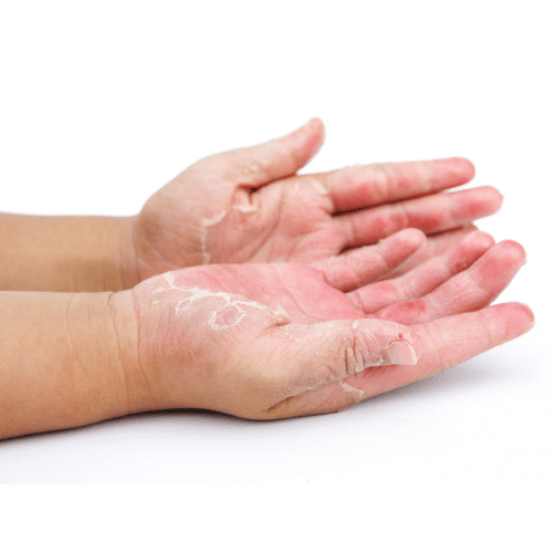 Contact Dermatitis - Causes of Skin Inflammation