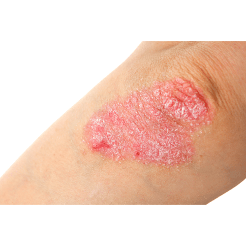 Eczema or Atopic dermatitis - Causes of Skin Inflammation