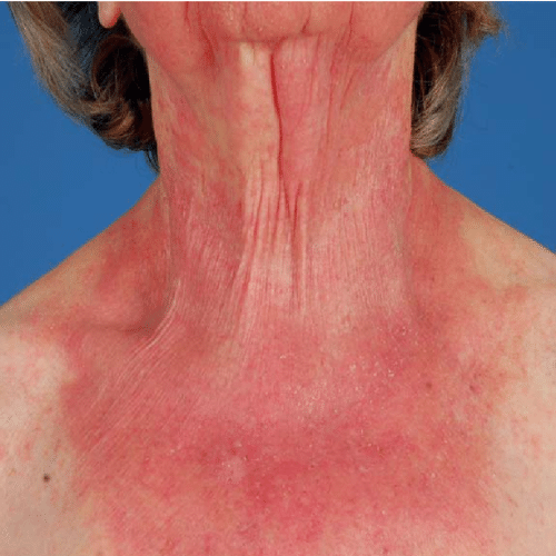 Photosensitivity - Causes of Skin Inflammation